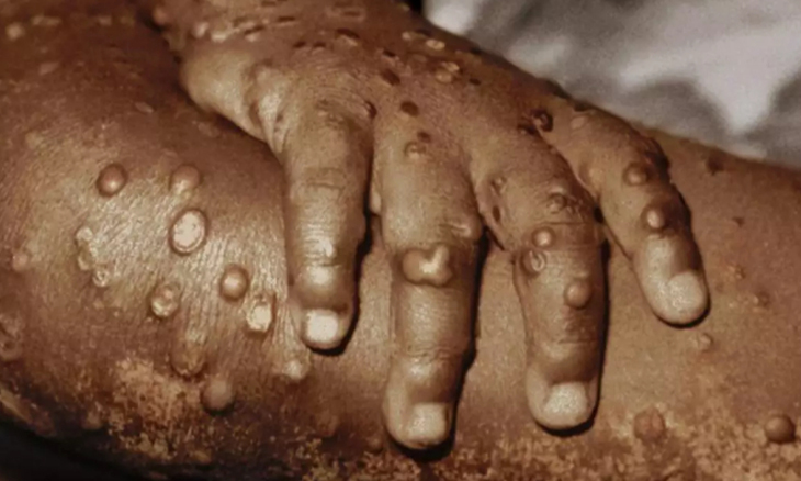 MINISTÉRIO DA SAÚDE ESCLARECE CASOS SUSPEITOS  DE MPOX  NO ICOLO E BENGO